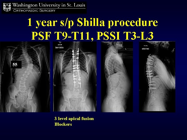 1 year s/p Shilla procedure PSF T 9 -T 11, PSSI T 3 -L