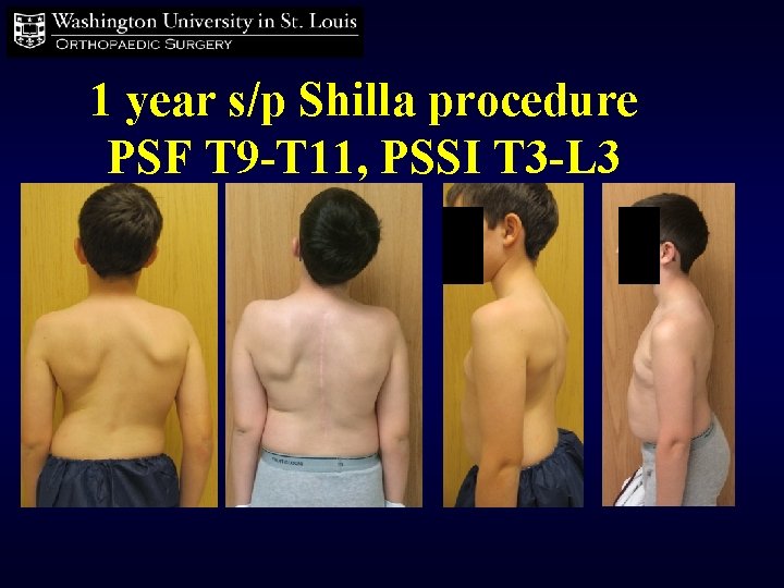 1 year s/p Shilla procedure PSF T 9 -T 11, PSSI T 3 -L