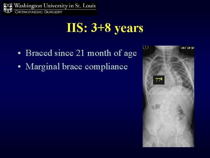 IIS: 3+8 years • Braced since 21 month of age • Marginal brace compliance