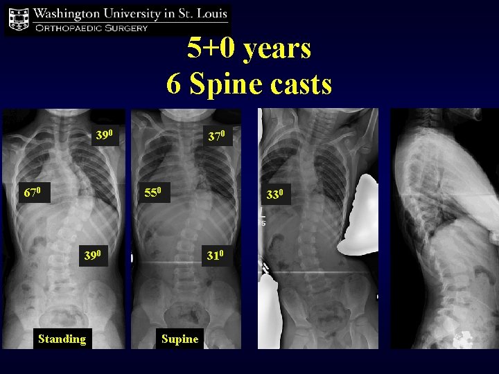 5+0 years 6 Spine casts 390 670 370 550 390 Standing 330 310 Supine