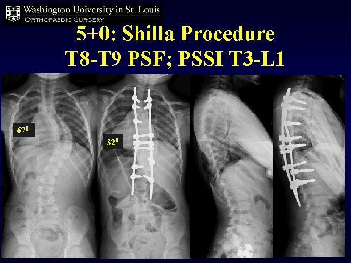 5+0: Shilla Procedure T 8 -T 9 PSF; PSSI T 3 -L 1 670