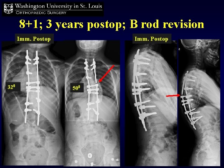 8+1; 3 years postop; B rod revision Imm. Postop 320 Imm. Postop 500 