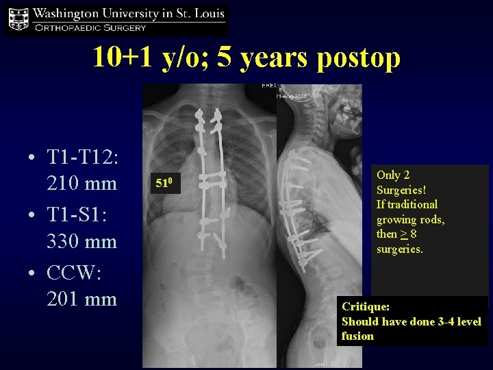 10+1 y/o; 5 years postop • T 1 -T 12: 210 mm • T