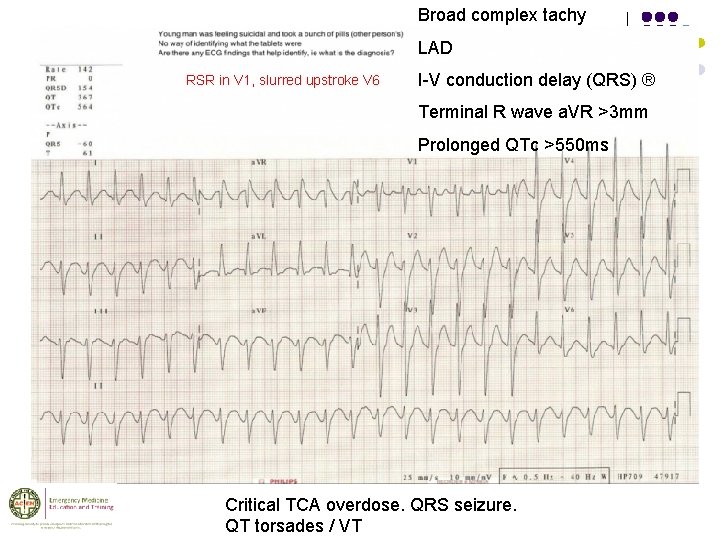 Broad complex tachy LAD RSR in V 1, slurred upstroke V 6 I-V conduction