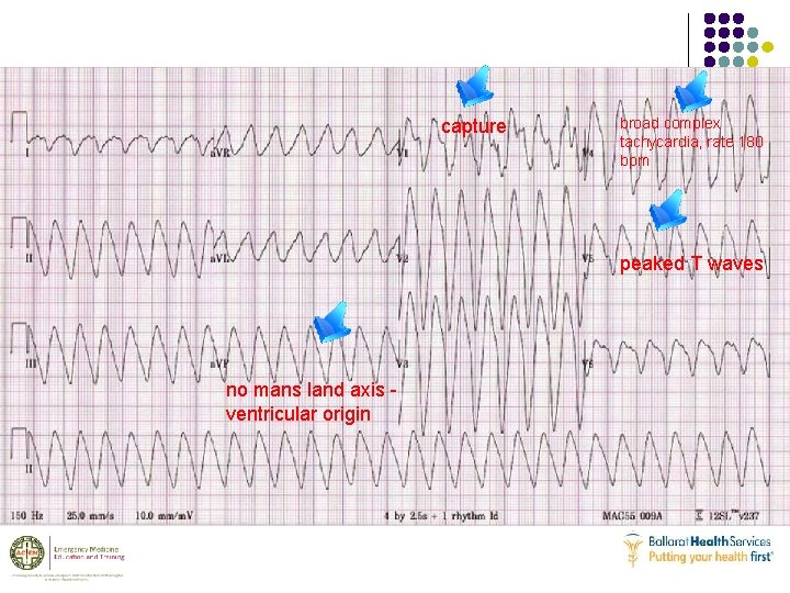 capture broad complex tachycardia, rate 180 bpm peaked T waves no mans land axis