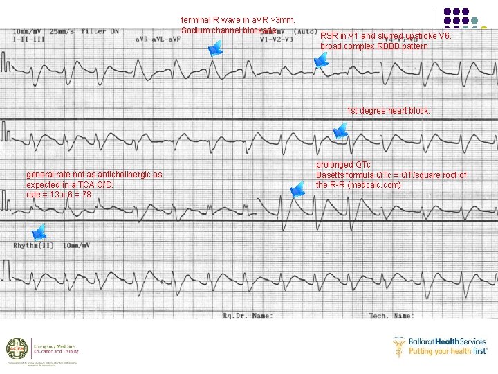 terminal R wave in a. VR >3 mm. Sodium channel blockade RSR in V