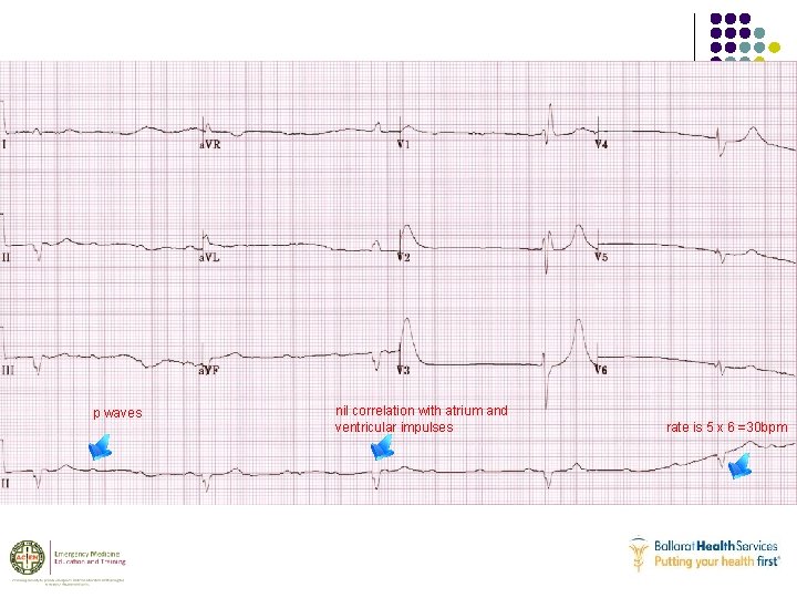 p waves nil correlation with atrium and ventricular impulses rate is 5 x 6