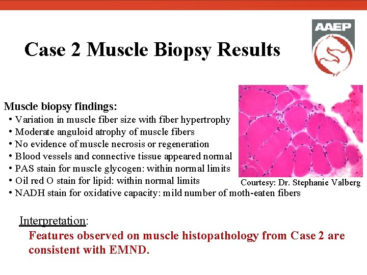  Case 2 Muscle Biopsy Results Muscle biopsy findings: • Variation in muscle fiber