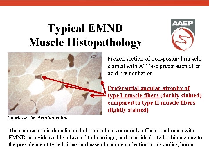  Typical EMND Muscle Histopathology Frozen section of non-postural muscle stained with ATPase preparation