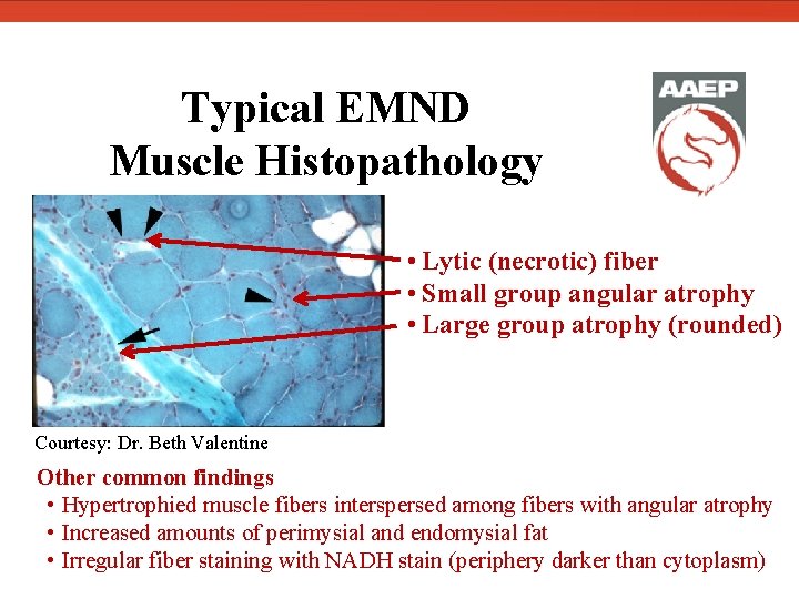  Typical EMND Muscle Histopathology • Lytic (necrotic) fiber • Small group angular atrophy