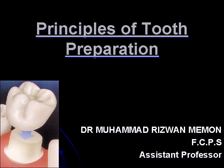 Principles of Tooth Preparation DR MUHAMMAD RIZWAN MEMON F. C. P. S Assistant Professor