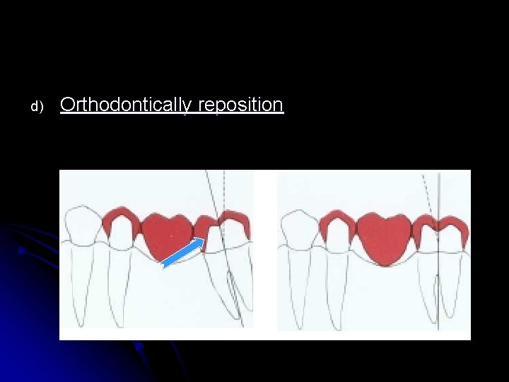 d) Orthodontically reposition 