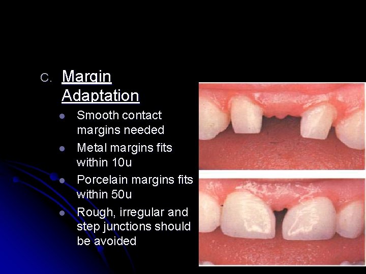 C. Margin Adaptation l l Smooth contact margins needed Metal margins fits within 10