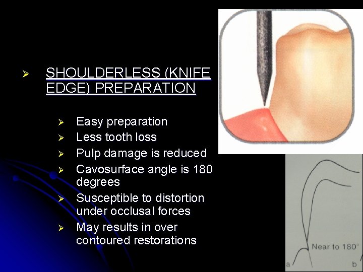 Ø SHOULDERLESS (KNIFE EDGE) PREPARATION Ø Ø Ø Easy preparation Less tooth loss Pulp