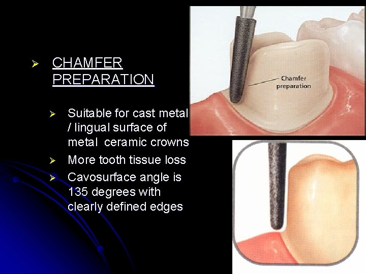 Ø CHAMFER PREPARATION Ø Ø Ø Suitable for cast metal / lingual surface of