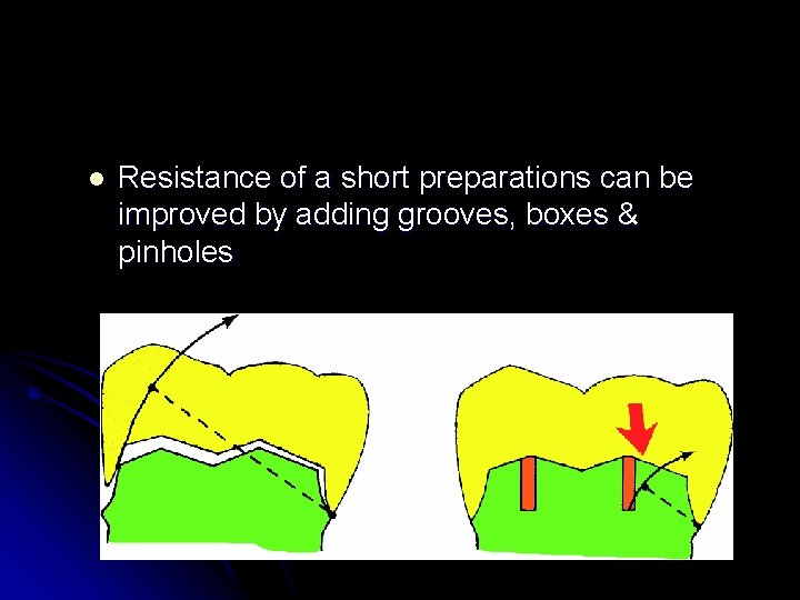 l Resistance of a short preparations can be improved by adding grooves, boxes &