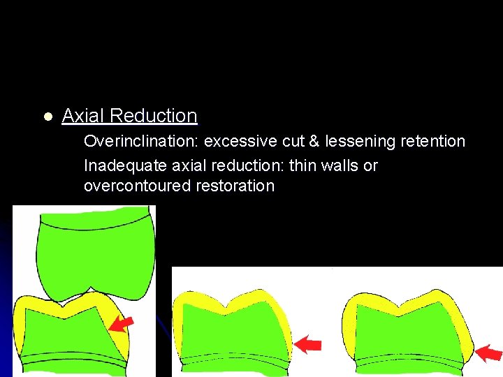 l Axial Reduction Overinclination: excessive cut & lessening retention Inadequate axial reduction: thin walls