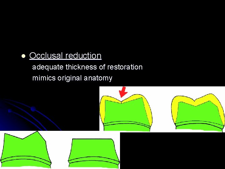 l Occlusal reduction adequate thickness of restoration mimics original anatomy 