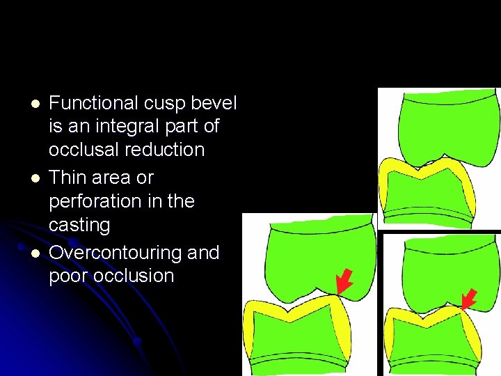 l l l Functional cusp bevel is an integral part of occlusal reduction Thin