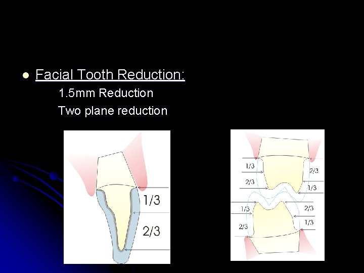 l Facial Tooth Reduction: 1. 5 mm Reduction Two plane reduction 