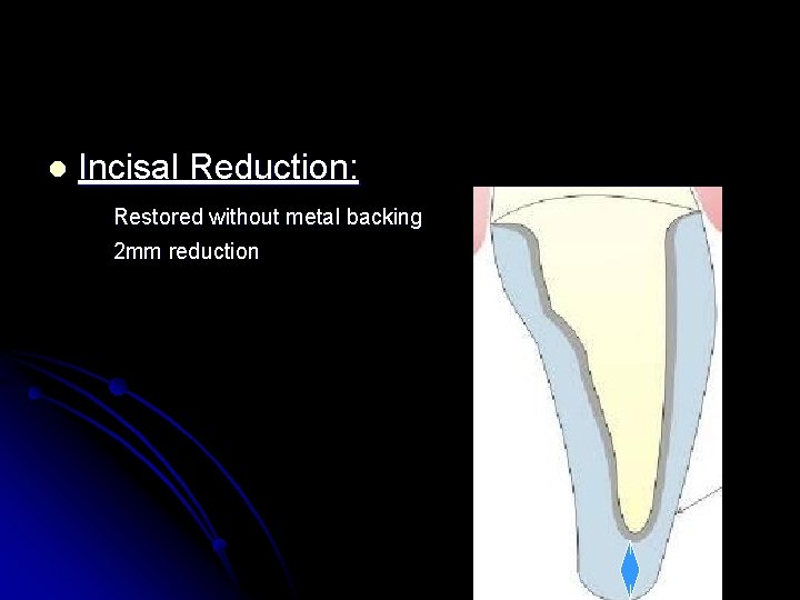 l Incisal Reduction: Restored without metal backing 2 mm reduction 