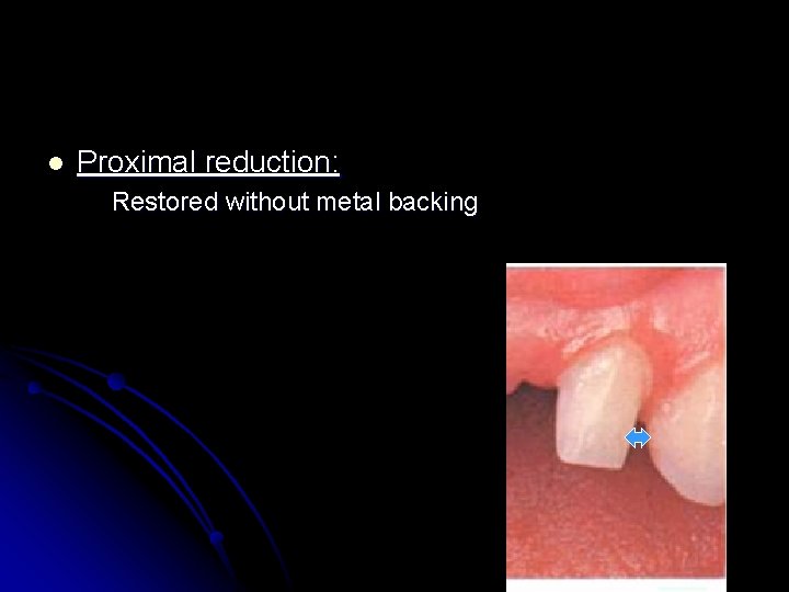 l Proximal reduction: Restored without metal backing 