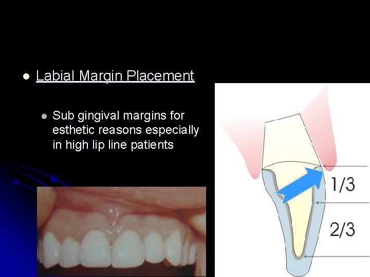 l Labial Margin Placement l Sub gingival margins for esthetic reasons especially in high