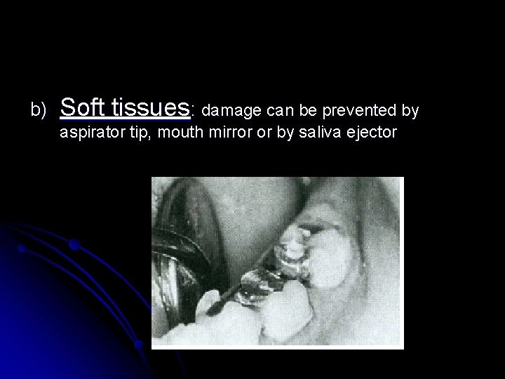 b) Soft tissues: damage can be prevented by aspirator tip, mouth mirror or by