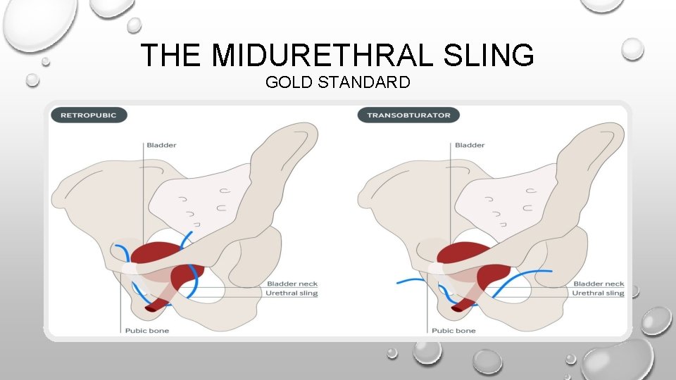 THE MIDURETHRAL SLING GOLD STANDARD 