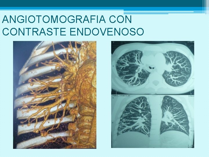 ANGIOTOMOGRAFIA CONTRASTE ENDOVENOSO 