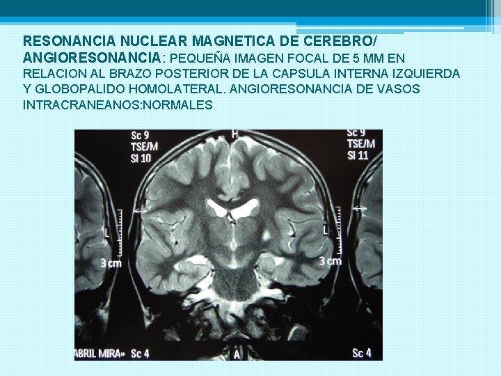 RESONANCIA NUCLEAR MAGNETICA DE CEREBRO/ ANGIORESONANCIA: PEQUEÑA IMAGEN FOCAL DE 5 MM EN RELACION