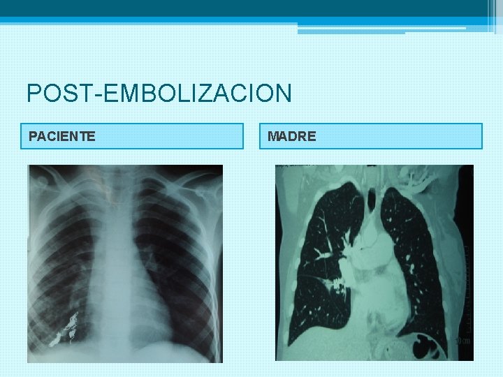 POST-EMBOLIZACION PACIENTE MADRE 