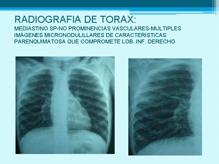 RADIOGRAFIA DE TORAX: MEDIASTINO SP-NO PROMINENCIAS VASCULARES-MULTIPLES IMÁGENES MICRONODULILLARES DE CARACTERISTICAS PARENQUIMATOSA QUE COMPROMETE