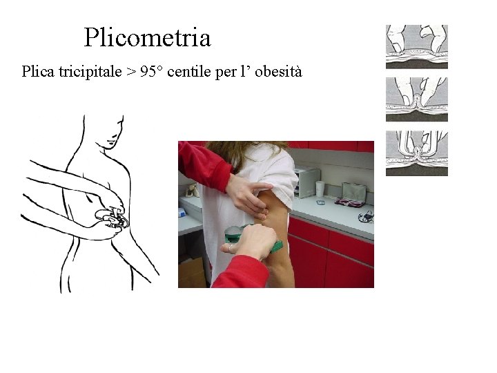 Plicometria Plica tricipitale > 95° centile per l’ obesità 