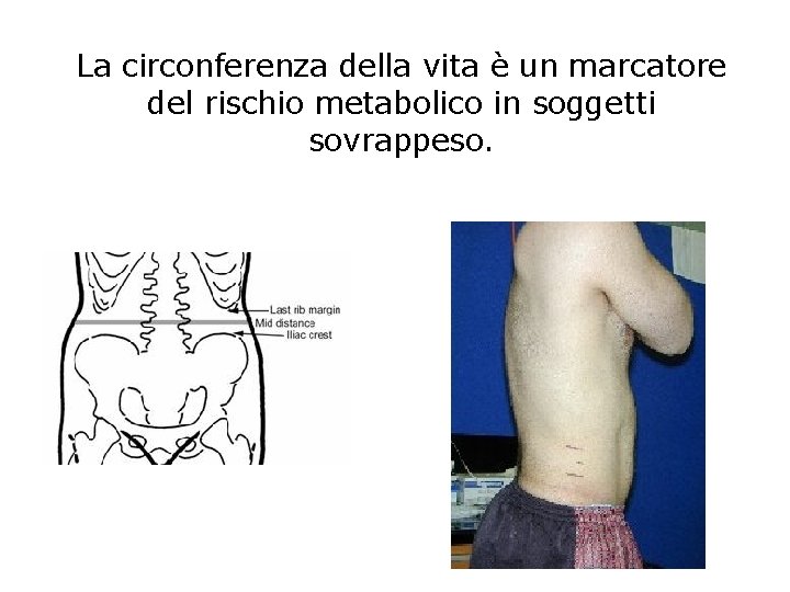 La circonferenza della vita è un marcatore del rischio metabolico in soggetti sovrappeso. 