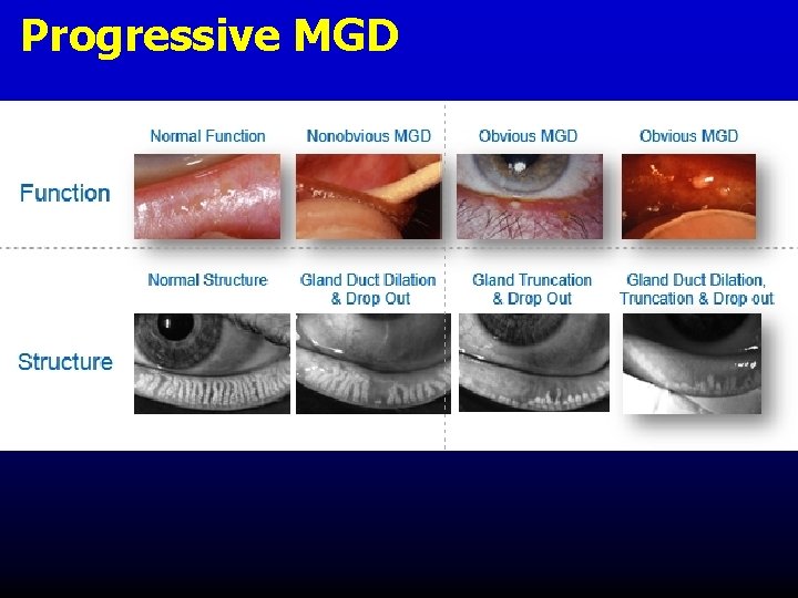 Progressive MGD Progressive MGD