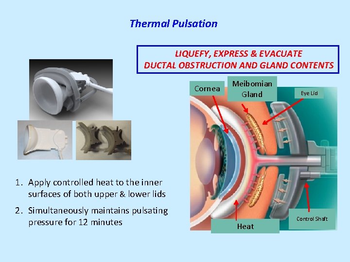 Thermal Pulsation LIQUEFY, EXPRESS & EVACUATE DUCTAL OBSTRUCTION AND GLAND CONTENTS Cornea Meibomian Gland Thermal Pulsation LIQUEFY, EXPRESS & EVACUATE DUCTAL OBSTRUCTION AND GLAND CONTENTS Cornea Meibomian Gland
