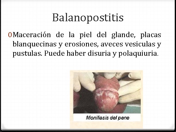 Balanopostitis 0 Maceración de la piel del glande, placas blanquecinas y erosiones, aveces vesiculas