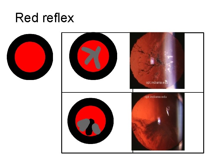 Red reflex 