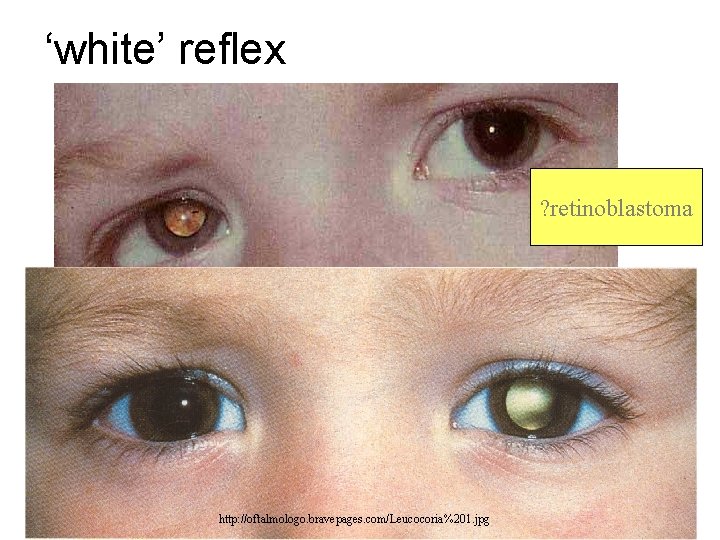 ‘white’ reflex ? retinoblastoma www. occhioallaretina. it/Immagini/leucocoria. JPG http: //oftalmologo. bravepages. com/Leucocoria%201. jpg 