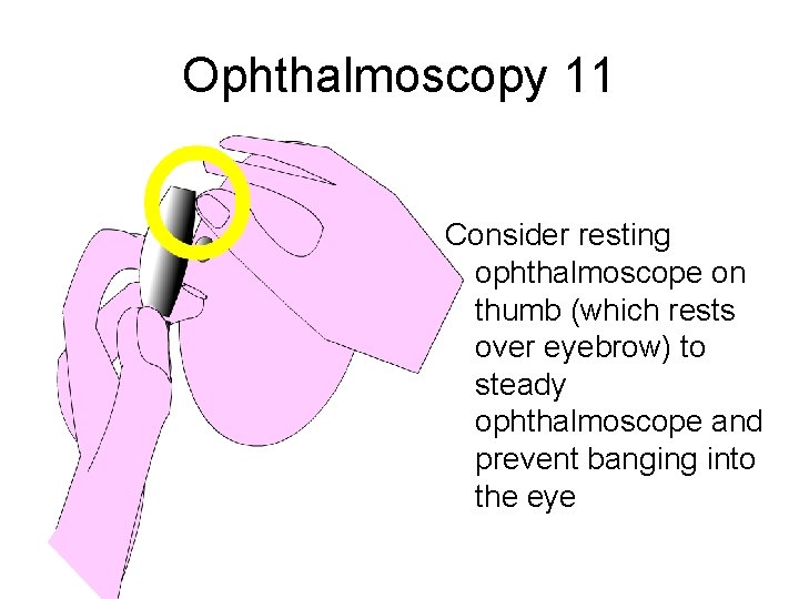 Ophthalmoscopy 11 Consider resting ophthalmoscope on thumb (which rests over eyebrow) to steady ophthalmoscope