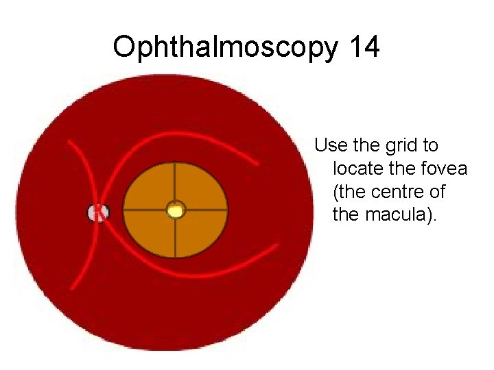 Ophthalmoscopy 14 Use the grid to locate the fovea (the centre of the macula).