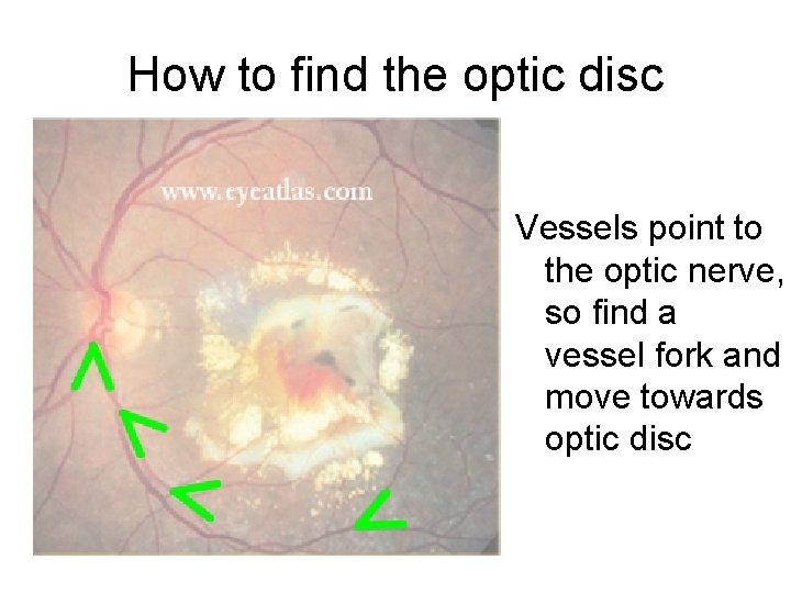 How to find the optic disc Vessels point to the optic nerve, so find