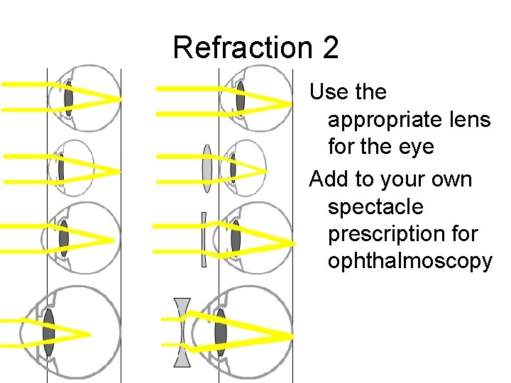 Refraction 2 Use the appropriate lens for the eye Add to your own spectacle