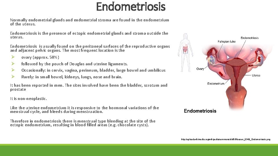 Endometriosis Normally endometrial glands and endometrial stroma are found in the endometrium of the