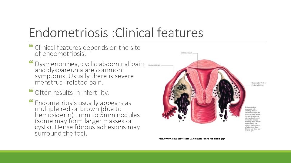 Endometriosis : Clinical features depends on the site of endometriosis. Dysmenorrhea, cyclic abdominal pain