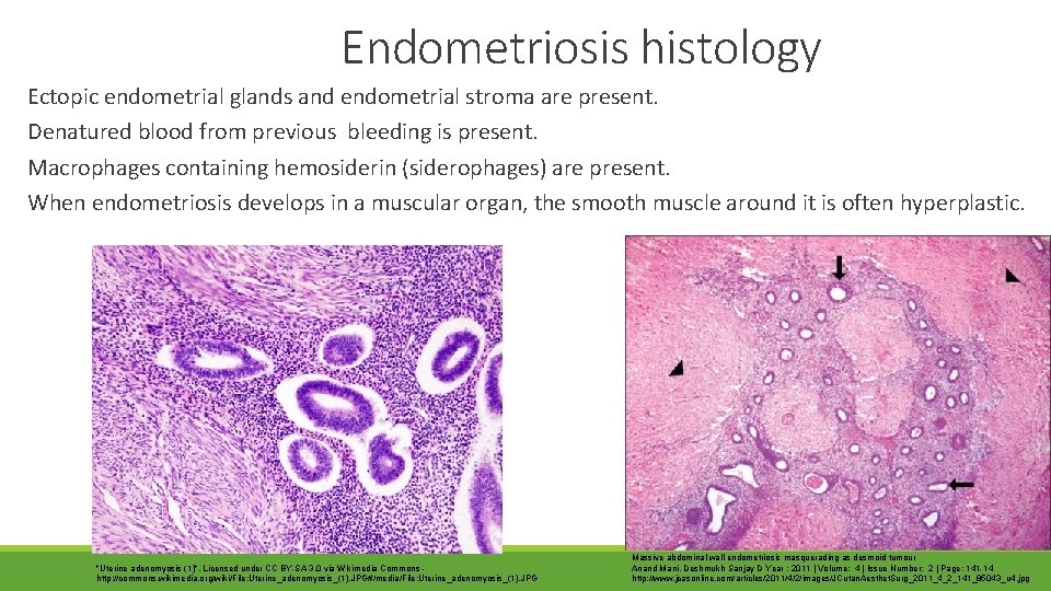 Endometriosis histology Ectopic endometrial glands and endometrial stroma are present. Denatured blood from previous