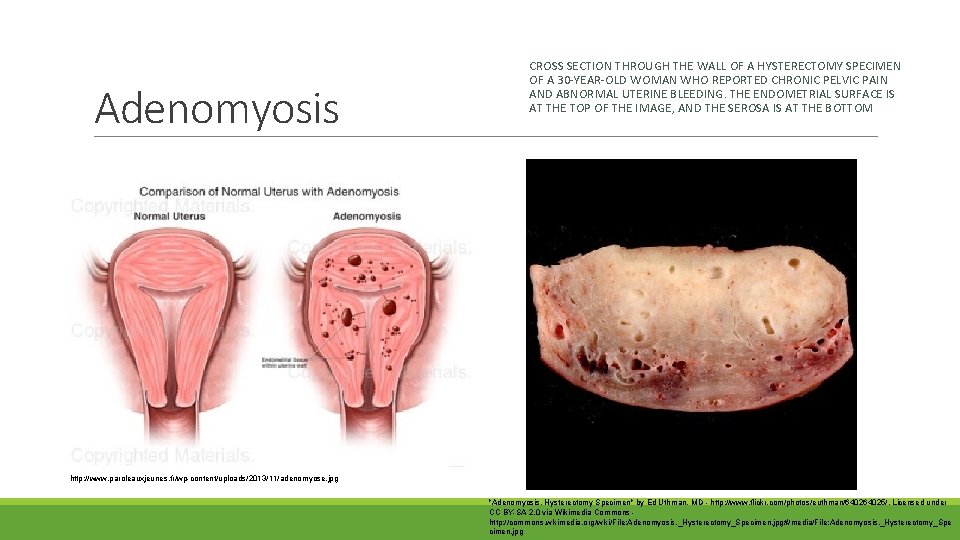 Adenomyosis CROSS SECTION THROUGH THE WALL OF A HYSTERECTOMY SPECIMEN OF A 30 -YEAR-OLD