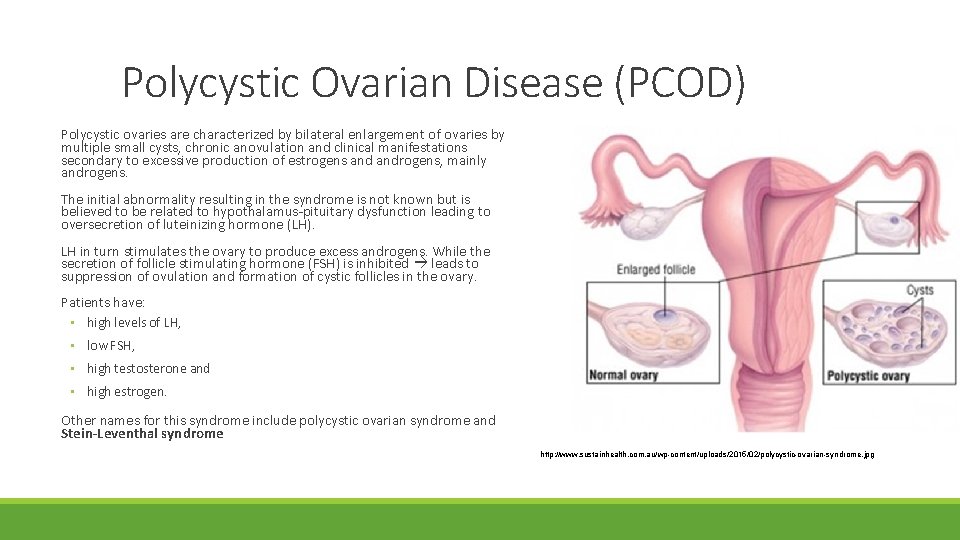 Polycystic Ovarian Disease (PCOD) Polycystic ovaries are characterized by bilateral enlargement of ovaries by