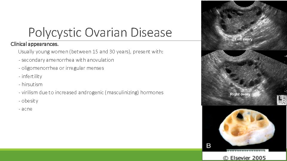 Polycystic Ovarian Disease Clinical appearances. Usually young women (between 15 and 30 years), present